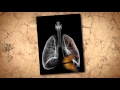 Mesothelioma asbestos