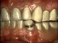 Protesis dentales